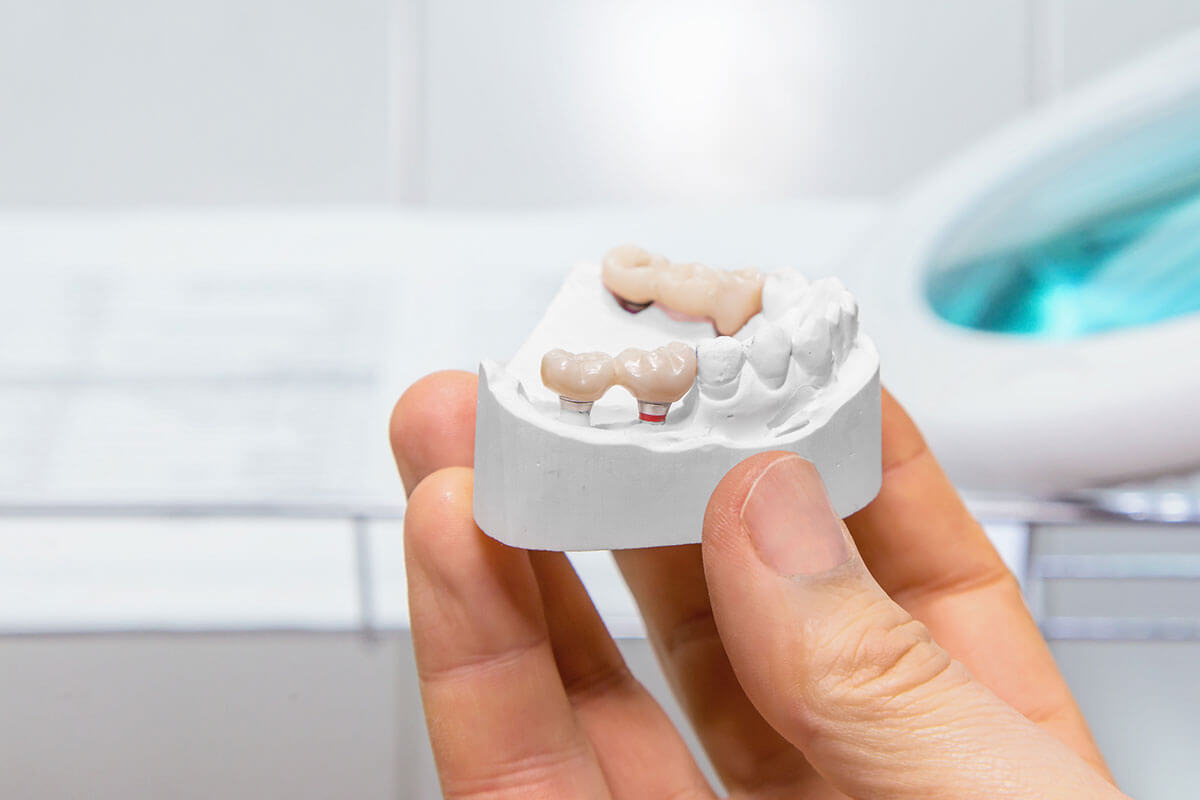 What Is A Dental Bridge?